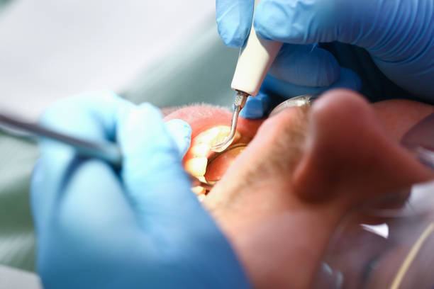 Best Broken or Cracked Tooth Emergency Dentist in Cave Spring, VA