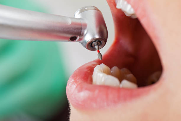 Best Emergency Dentist for Lost Fillings or Crowns in Cave Spring, VA